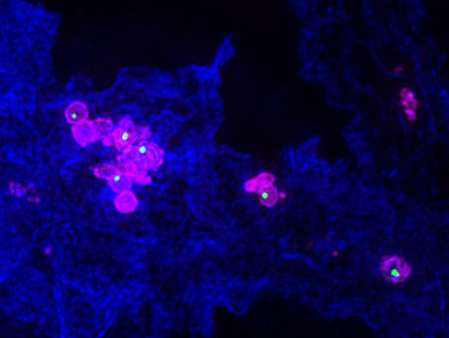 Mit Francisella novicida (pink) infizierte Makrophage Mit Francisella novicida (pink) infizierte Makrophage